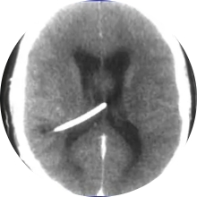 Hipertension-endocraneana-grave-por-hidrocefalia