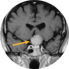 Meningioma-del-tuberculum-selar
