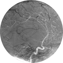 Tumor-cerebral-de-hemisferio-derecho-angiografia