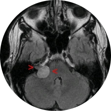akustikusneurinom_Mrt