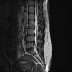 Hernia Discal Lumnar